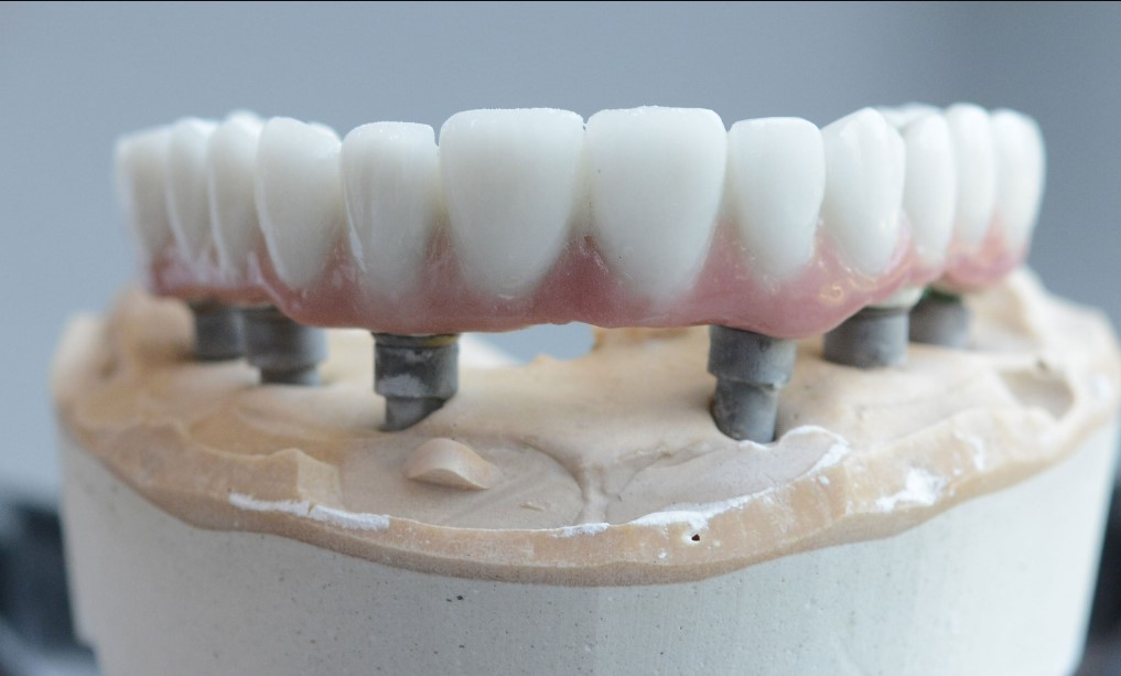 mouth dental implants